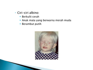  Ciri-ciri albino:
    Berkulit cerah
    Anak mata yang berwarna merah muda
    Berambut putih
 