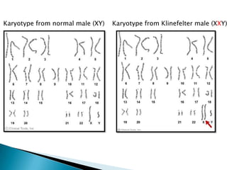 Karyotype from normal male (XY)   Karyotype from Klinefelter male (XXY)
 