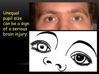 Unequal
pupil size
can be a sign
of a serious
brain injury.
 
