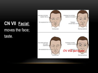CN VII Facial:
moves the face;
taste.
CN VII paralysis
 