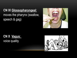 CN IX Glossopharyngeal:
moves the pharynx (swallow,
speech & gag)
CN X Vagus:
voice quality
 