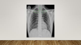 Normal chest X ray radiography interpretation | PPTX