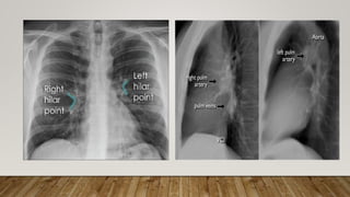 Normal Radiography Normal chest X ray radiography interpretation | PPTX