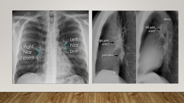 Normal chest X ray radiography interpretation | PPTX | Lung and ...