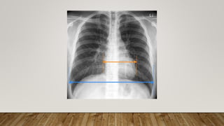 Normal chest X ray radiography interpretation | PPTX