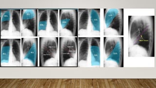 Normal chest X ray radiography interpretation | PPTX