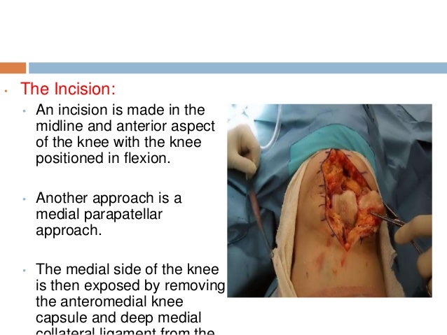 Treatment of osteoarthritis of knee