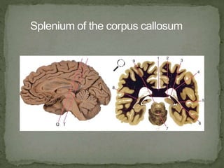 Right Splenium brain sectional anatomy | PPTX