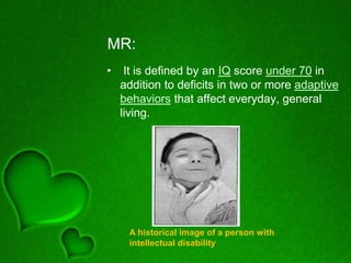 MR:
• It is defined by an IQ score under 70 in
addition to deficits in two or more adaptive
behaviors that affect everyday, general
living.
A historical image of a person with
intellectual disability
 