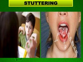 STUTTERING
 
