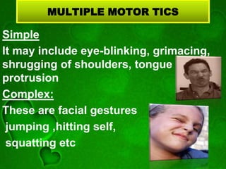 MULTIPLE MOTOR TICS
Simple
It may include eye-blinking, grimacing,
shrugging of shoulders, tongue
protrusion
Complex:
These are facial gestures
jumping ,hitting self,
squatting etc
 