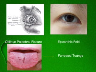 Oblique Palpebral Fissure Epicanthic Fold
Furrowed Tounge
 