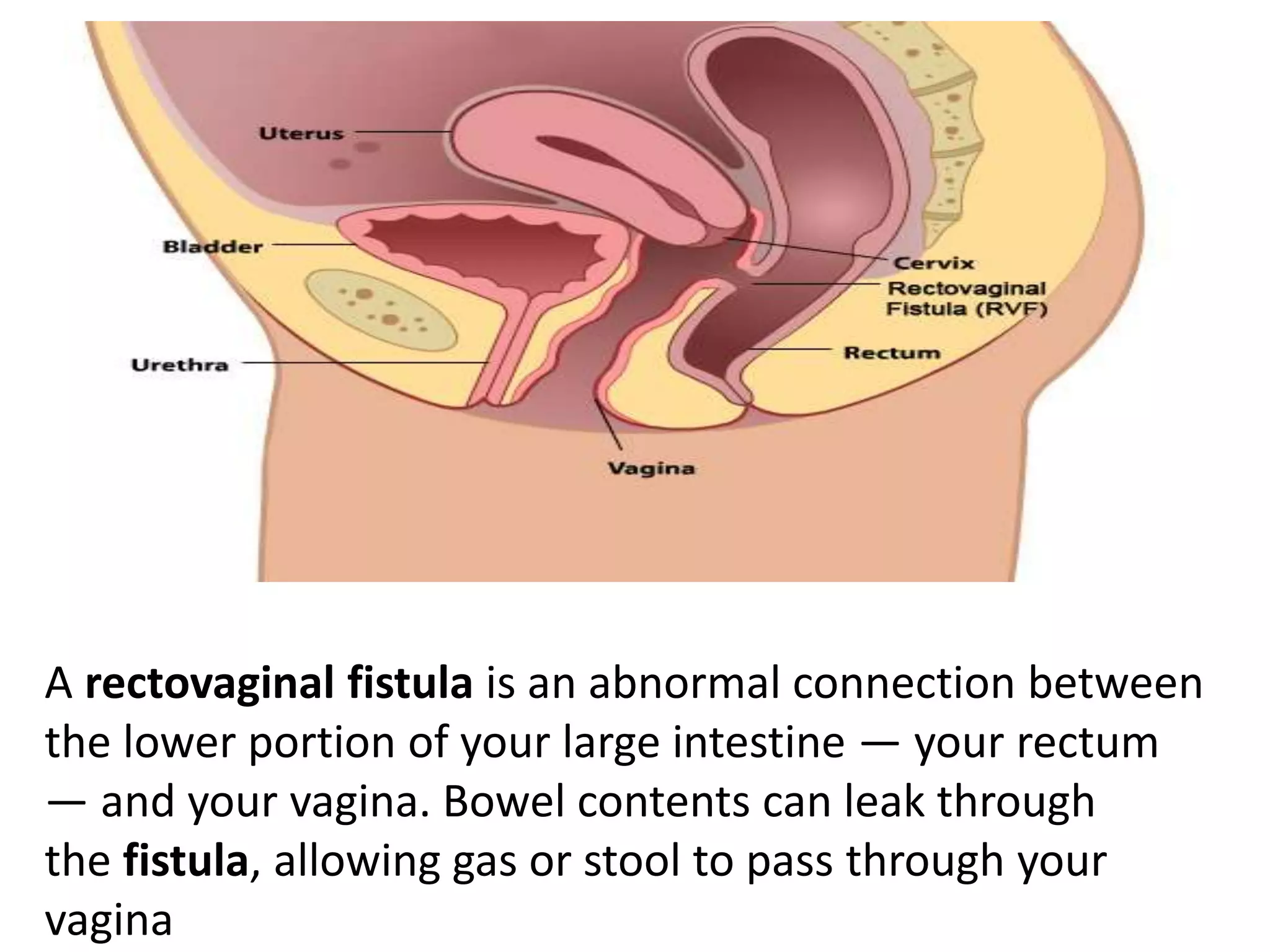 A rectovaginal fistula is an abnormal connection between
the lower portion of your large intestine — your rectum
— and your vagina. Bowel contents can leak through
the fistula, allowing gas or stool to pass through your
vagina
 