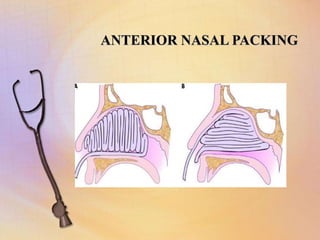 ANTERIOR NASAL PACKING
 