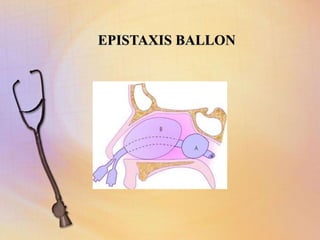 EPISTAXIS BALLON
 
