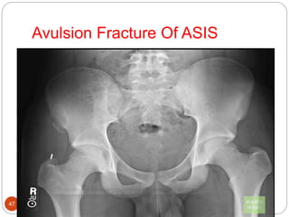 Applied Anatomy of Hip Joint | PPTX