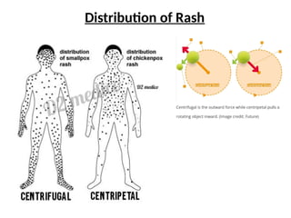 ppt of paediatric chicken pox and tetanus with vignette.pptx