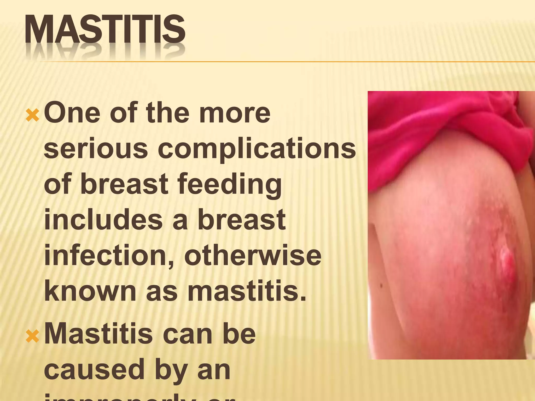 Ppt of problems and complication of breast feeding ppt (madam kalyani ...