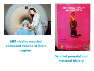 MRI studies reported
decreased volume of brain
regions
Detailed prenatal and
maternal history
 