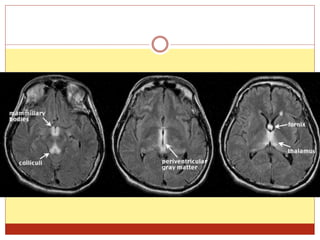 Ppt on alcohol in neurology | PPTX