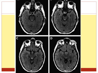 Ppt on alcohol in neurology | PPTX