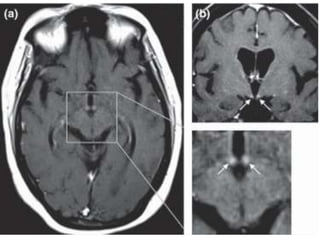 Ppt on alcohol in neurology | PPTX