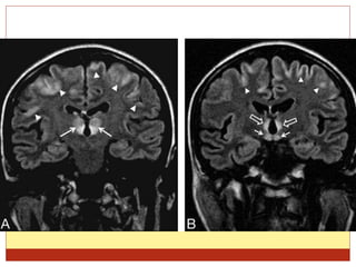 Ppt on alcohol in neurology | PPTX