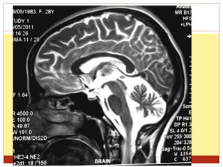 Ppt on alcohol in neurology | PPTX