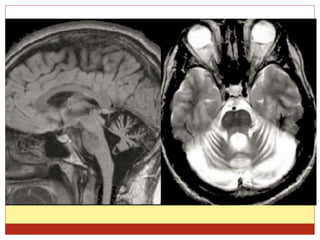 Ppt on alcohol in neurology | PPTX
