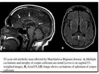 Ppt on alcohol in neurology | PPTX