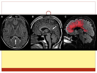Ppt on alcohol in neurology | PPTX