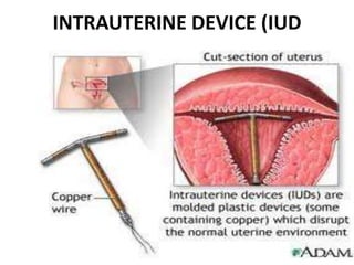 INTRAUTERINE DEVICE (IUD
 