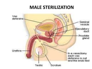 MALE STERILIZATION
.
 