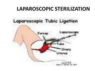 LAPAROSCOPIC STERILIZATION
 
