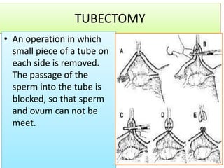 TUBECTOMY
• An operation in which
small piece of a tube on
each side is removed.
The passage of the
sperm into the tube is
blocked, so that sperm
and ovum can not be
meet.
 