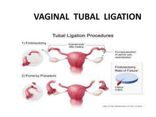 VAGINAL TUBAL LIGATION
 