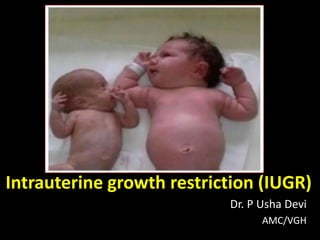 Intrauterine growth restriction (IUGR)
Dr. P Usha Devi
AMC/VGH
 