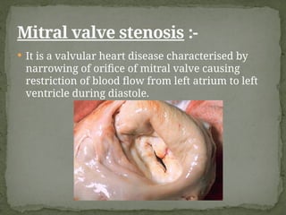 Mitral valve stenosis.pptx. . | PPTX