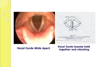 Vocal Cords Wide Apart
Vocal Cords loosely held
together and vibrating
 