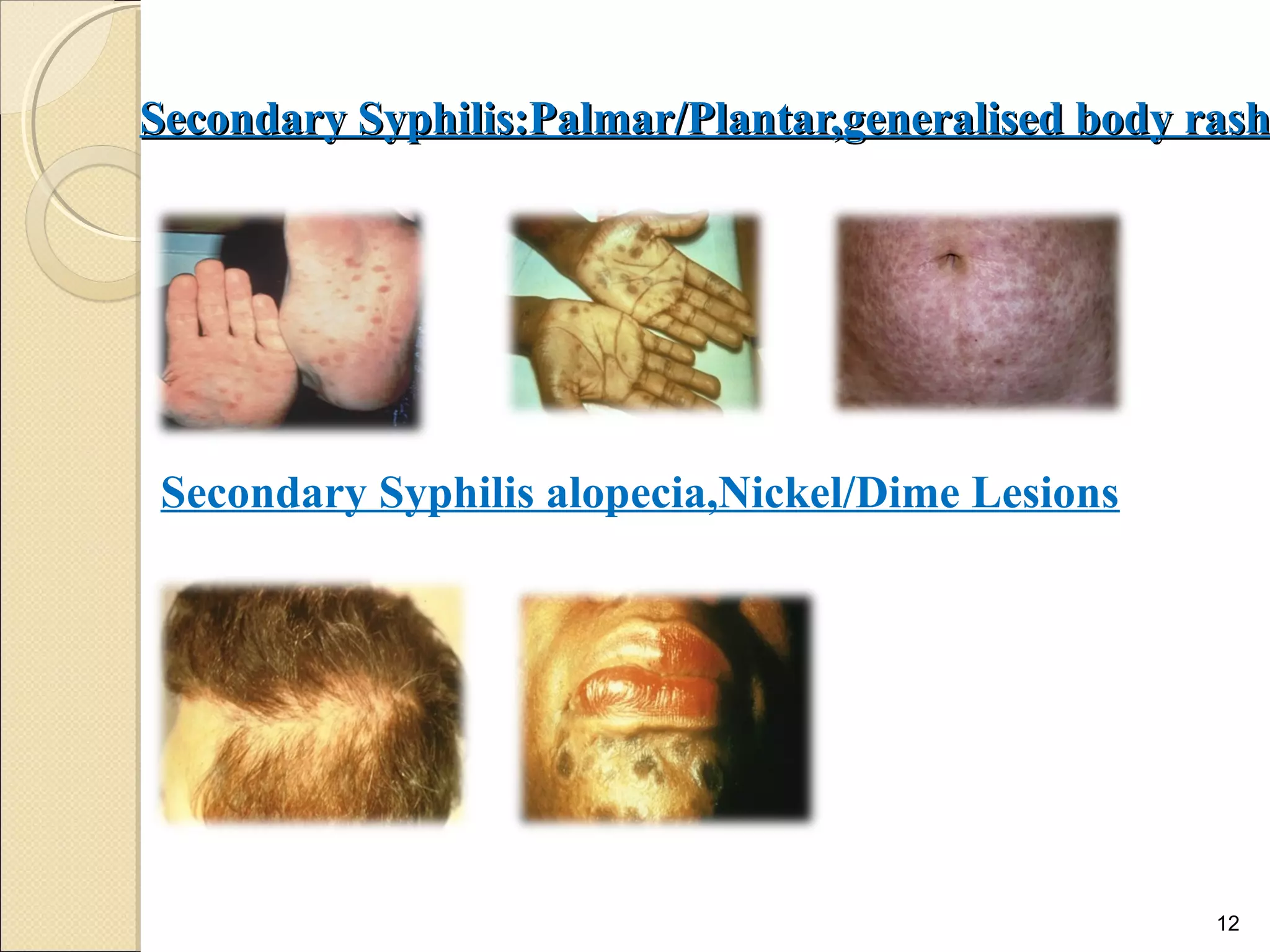 Secondary Syphilis:Palmar/Plantar,generalised body rashSecondary Syphilis:Palmar/Plantar,generalised body rash
12
Secondary Syphilis alopecia,Nickel/Dime Lesions
 