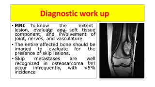 Skip Bone PPT osteosarcoma.pptx