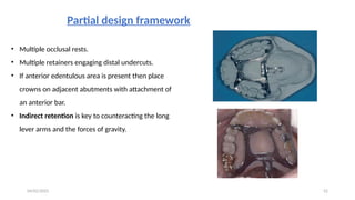 Presentation on palatopharyngeal prosthesis. | PPTX