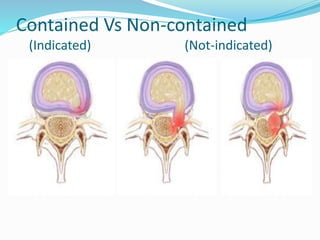 Contained Vs Non-contained
(Indicated) (Not-indicated)
 