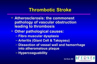 Thrombotic Stroke Atherosclerosis: the commonest pathology of vascular obstruction leading to thrombosis Other pathological causes: Fibro muscular dysplasia Arteritis (Giant Cell & Takayasu) Dissection of vessel wall and hemorrhage into atheromatous plaque Hypercoaguability 