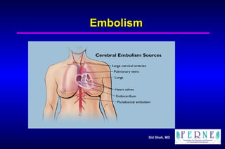 Embolism 