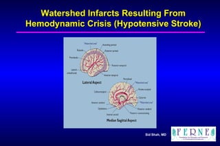 Watershed Infarcts Resulting From Hemodynamic Crisis (Hypotensive Stroke) 