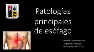 Patologías
principales
de esófago
Nombre: Daniel Reyes Jara
Asignatura: radiología 2
Docente: José Alonso Díaz
 