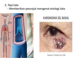 2. Tepi luka
- Memberikan petunjuk mengenai etiologi luka
 