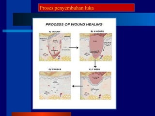 Proses penyembuhan luka
 