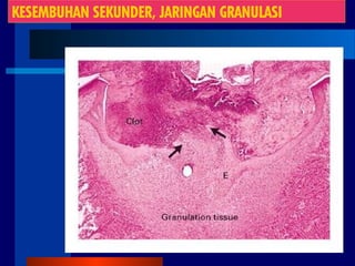 KESEMBUHAN SEKUNDER, JARINGAN GRANULASI
 